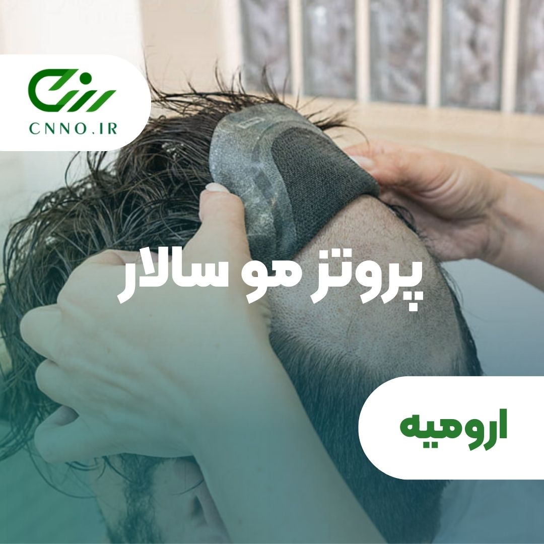 پروتز مو سالار در ارومیه - سینو